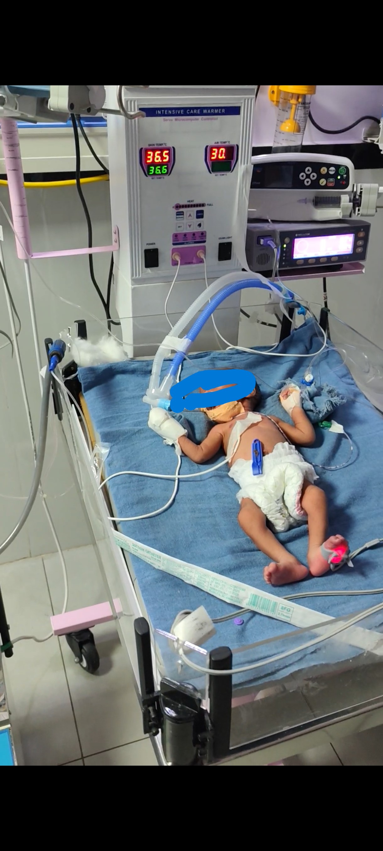 nicu very low birth weight
